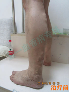 治疗前 (29).jpg